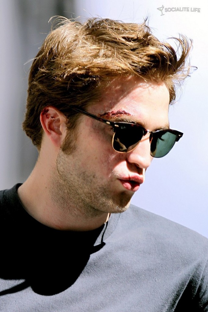 rob-bruised rob-bruised